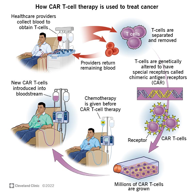 car-t-cell-therapy-israel-process.jpg